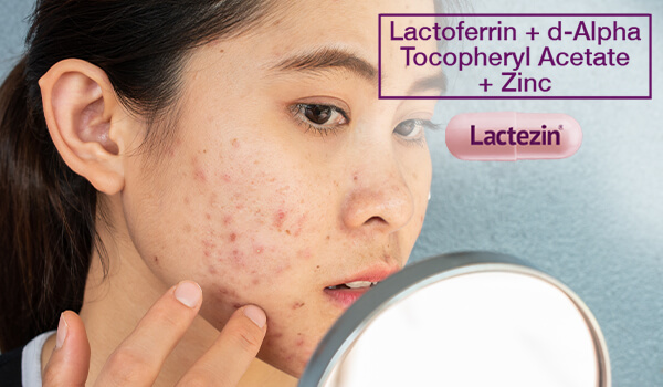 5 Causes And Treatments Of Acne Adult