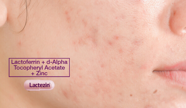 7 Effective Ways To Lighten Acne Scars