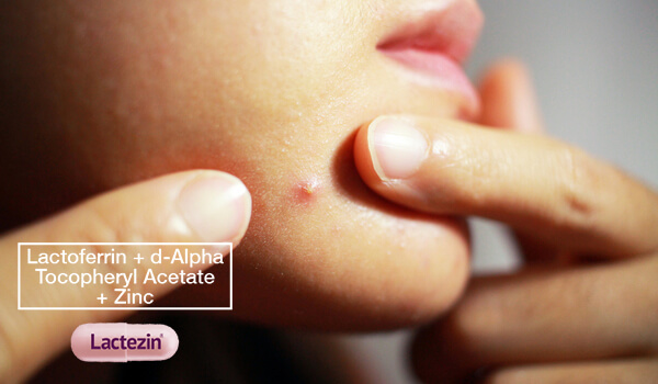 Causes And Treatment Of Pimples On Chin