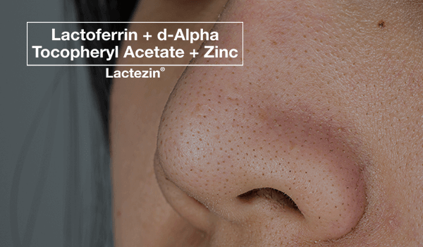 How To Prevent And Get Rid Of Whiteheads On Face
