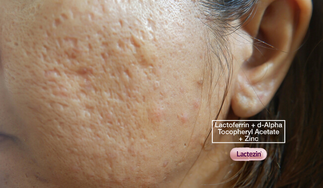 Pimples And Acne Scars Easy Remedies