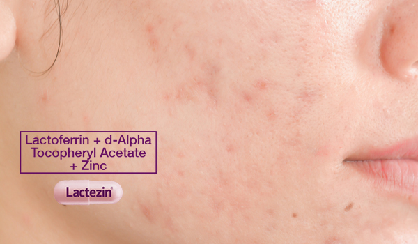 7 Tried and Tested Ways to Lighten Acne Scars Lactezin