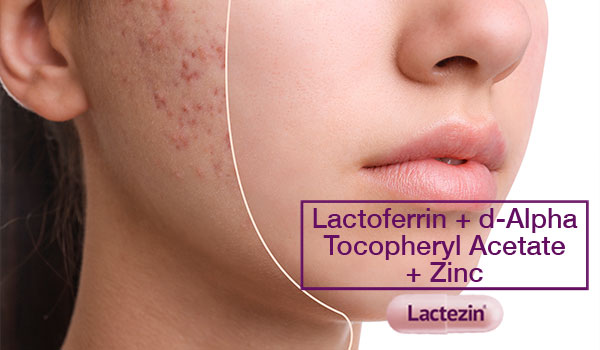 acne-scars-and-what-experts-recommend-updated