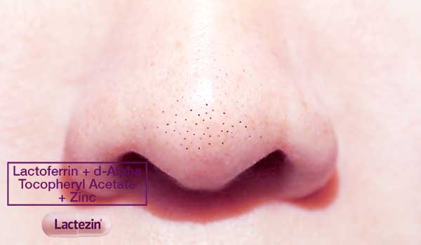 Sebaceous Filaments or Blackheads on Nose - Lactezin