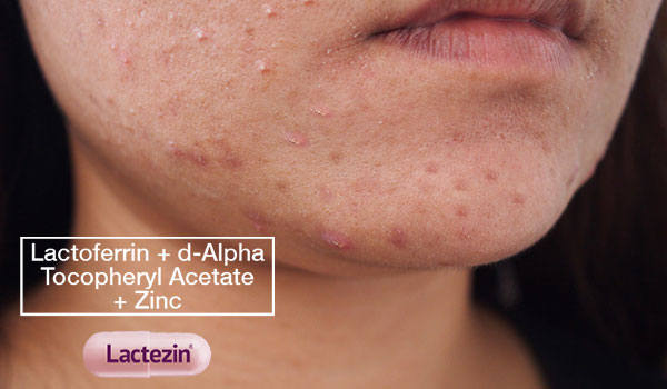 Heres Everything You Need To Know About Fungal Acne Lactezin