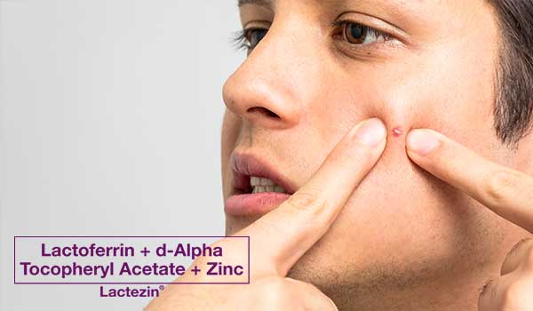 acne-in-men-101