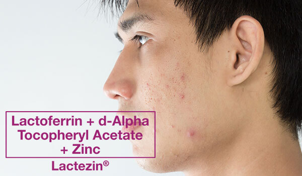 what is cystic acne and how to get rid of them