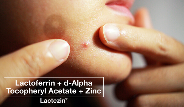 causes_of_acne_on_the_chin