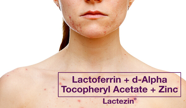 Here's Everything You Need To Know About Fungal Acne - Lactezin