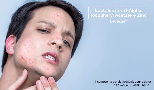 lactezin-article-pimples-on-the-forehead-chin-nose-what-causes-them