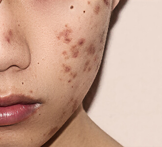 common types of acne scars and how to get rid of them