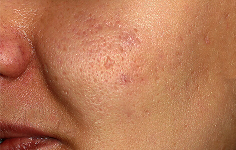 how to get rid of keloid acne scars