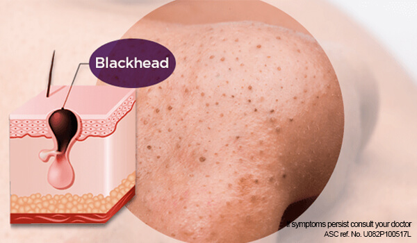 blackheads facts, causes and treatments