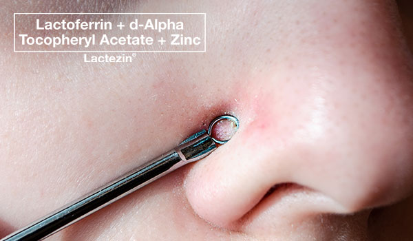 Here's Why The Whiteheads on Your Nose Keep Coming Back - Lactezin